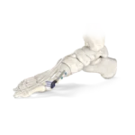 Centrolock® Guided Transverse Osteotomy System