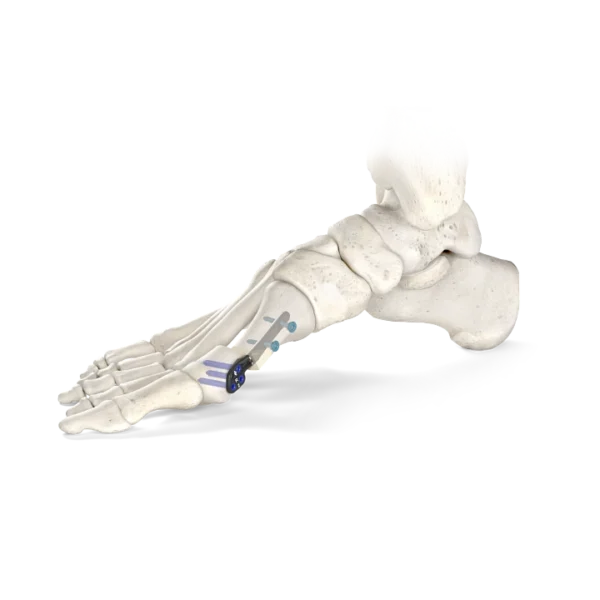 Centrolock® Guided Transverse Osteotomy System