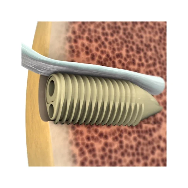 Eclipse™ Tenodesis Implant - Image 4