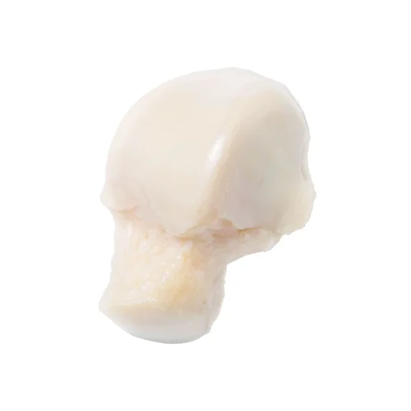 Fresh-stored Osteochondral Talus Allograft