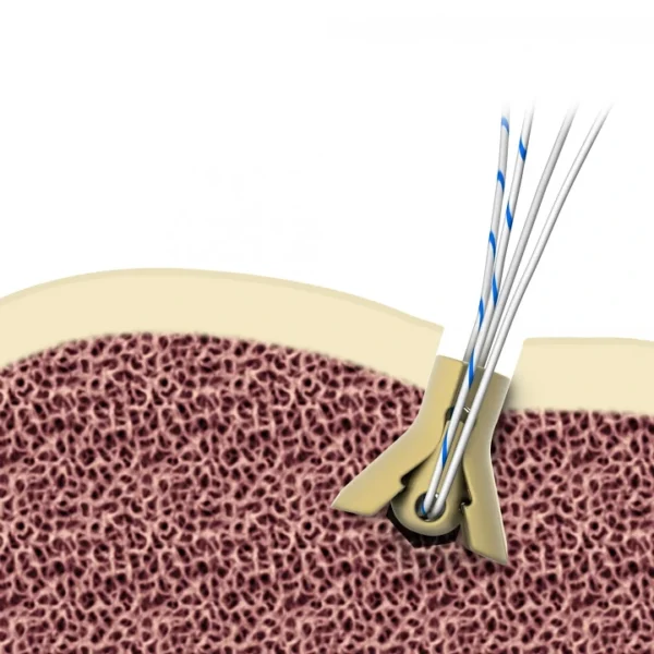 Morphix XT® Suture Anchor - Image 4