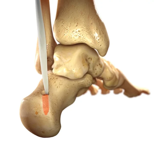 Eclipse™ Tenodesis Implant - Image 3