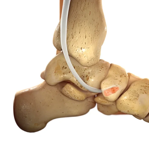 Eclipse™ Tenodesis Implant - Image 2