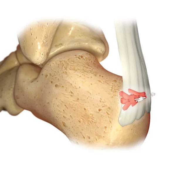 Morphix XT® Suture Anchor - Image 3