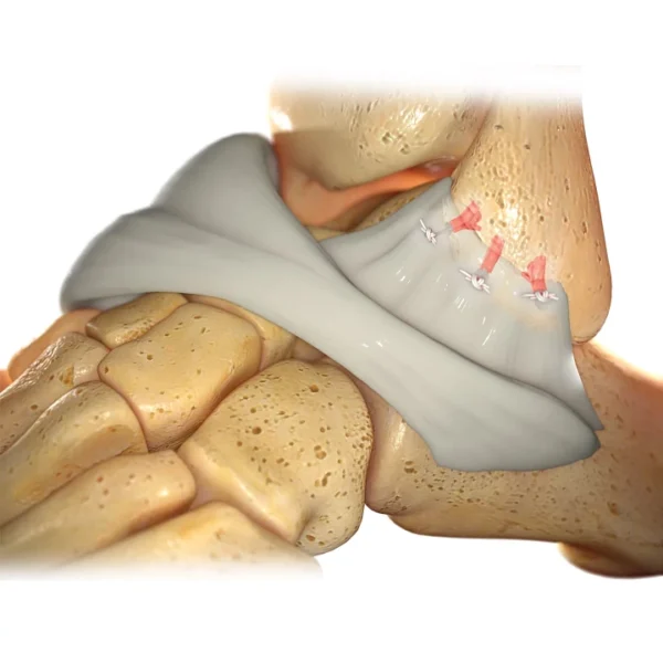 Morphix XT® Suture Anchor - Image 2