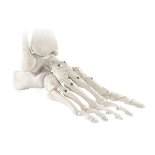 PECA-C® Compressive Implants