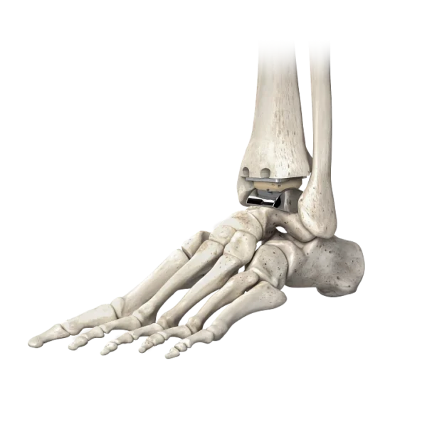 STAR® Ankle