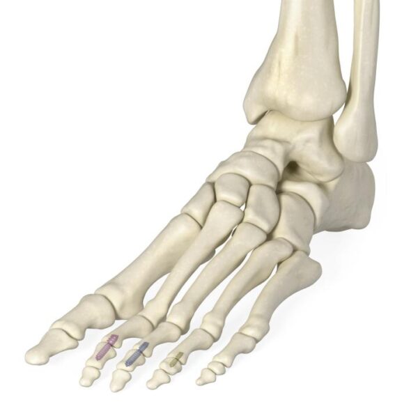 Two-Step Hammertoe Implant System